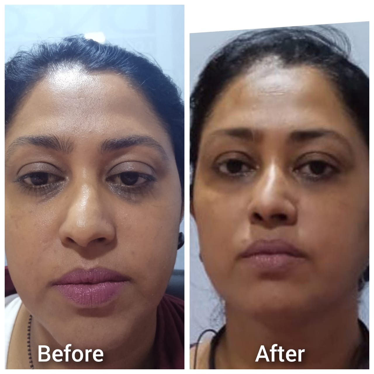Hair Transplant Transformation 1